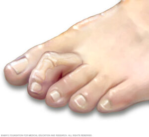 Hammertoe