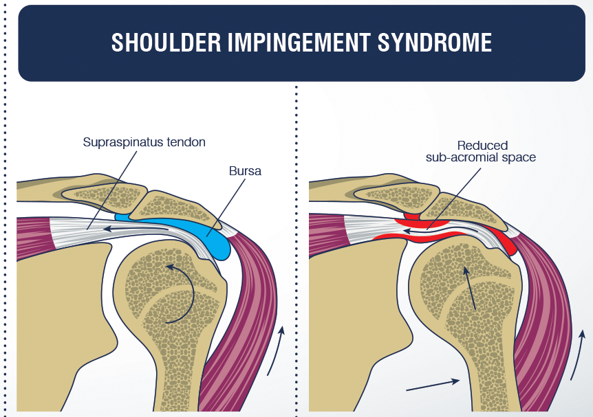 Shoulder impingement