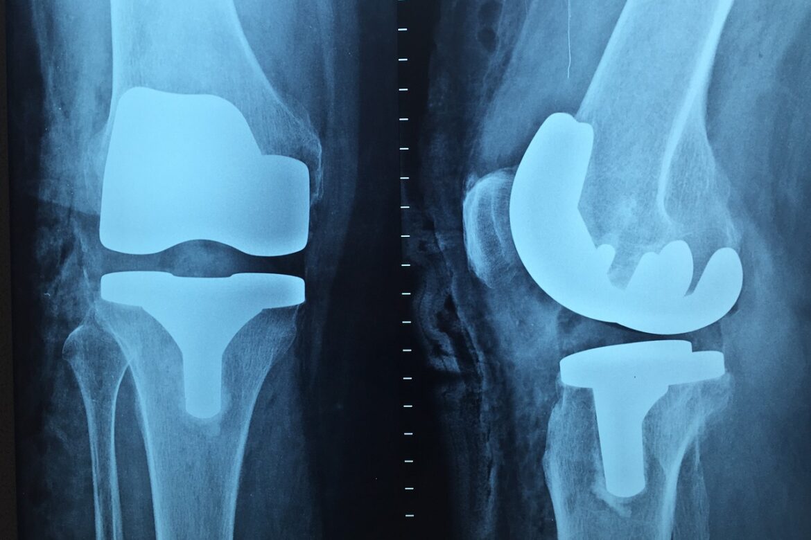 dry needling and knee replacements image of knee replacement x ray