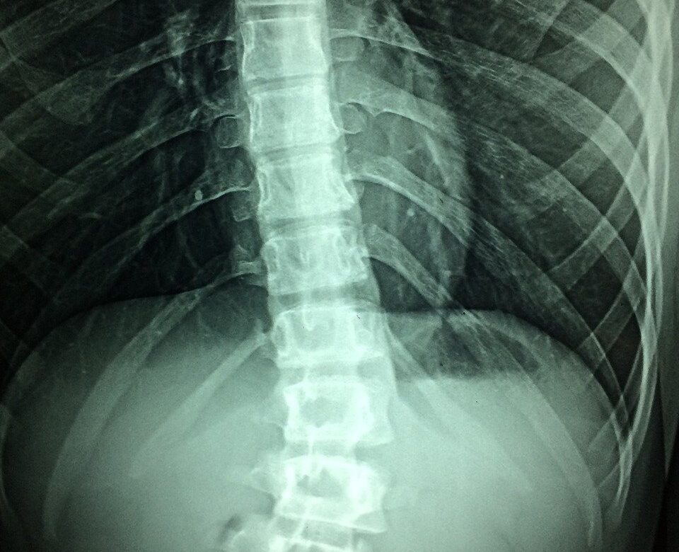 understanding the spine: scoliosis