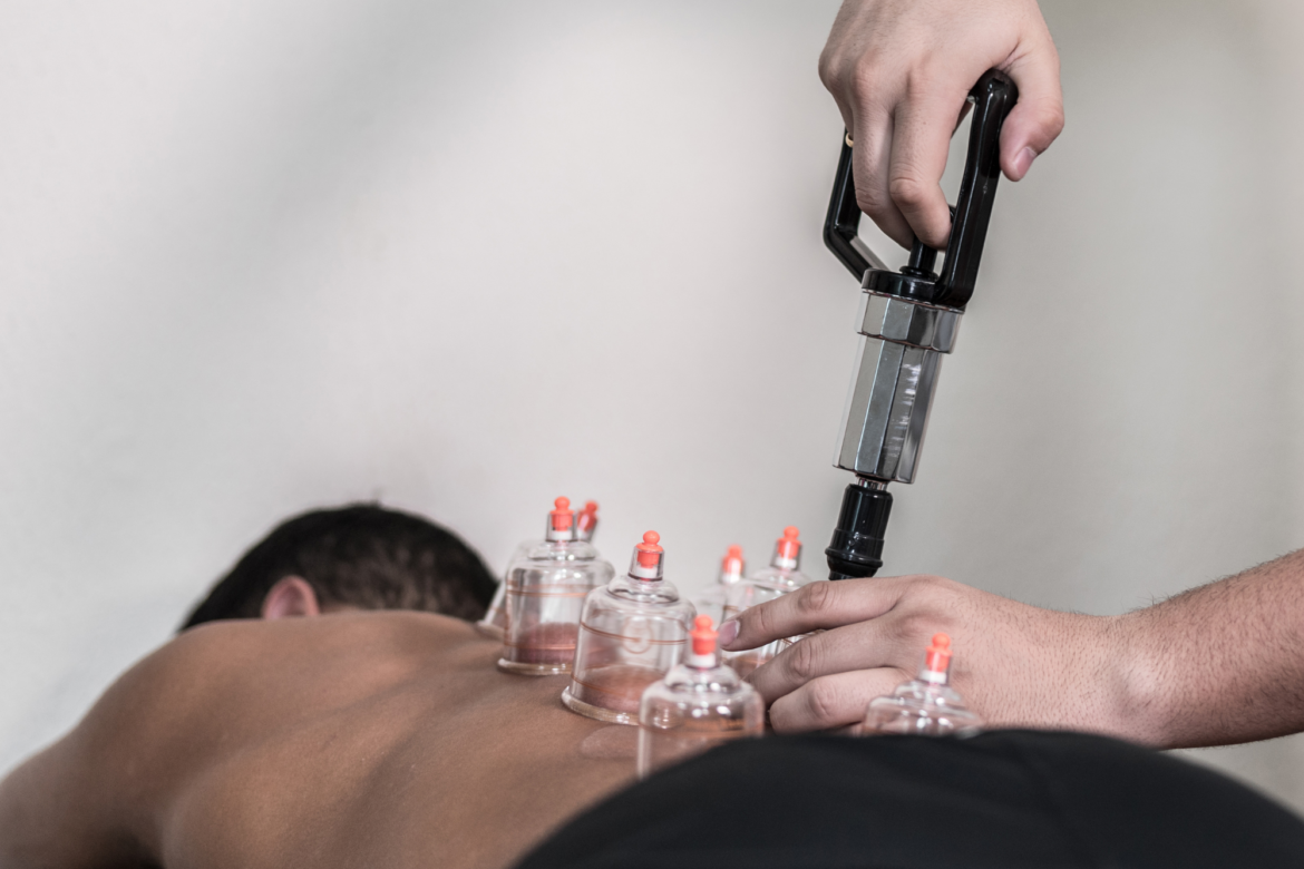 Treatment Spotlight: Cupping