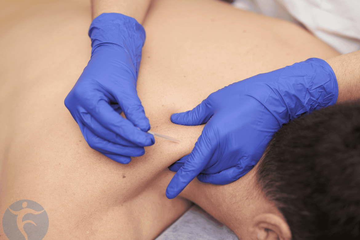 Dry Needling for PT?