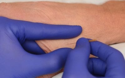 Dry Needling – All you need to know