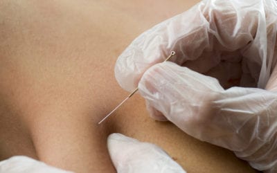 Dry Needling – What You Need To Know