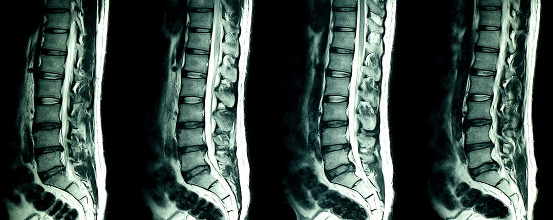 MRI of spine