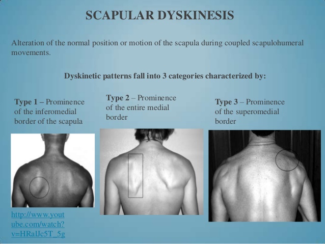 Scapular Dyskinesis