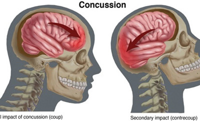 What Is A Concussion?