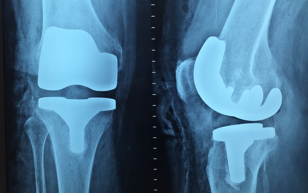 dry needling and knee replacements image of knee replacement x ray