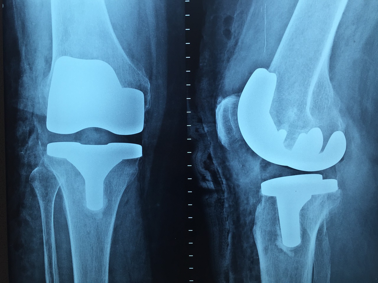  Knee Replacement - Physical Therapy