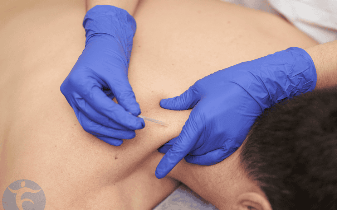 Dry Needling for PT?