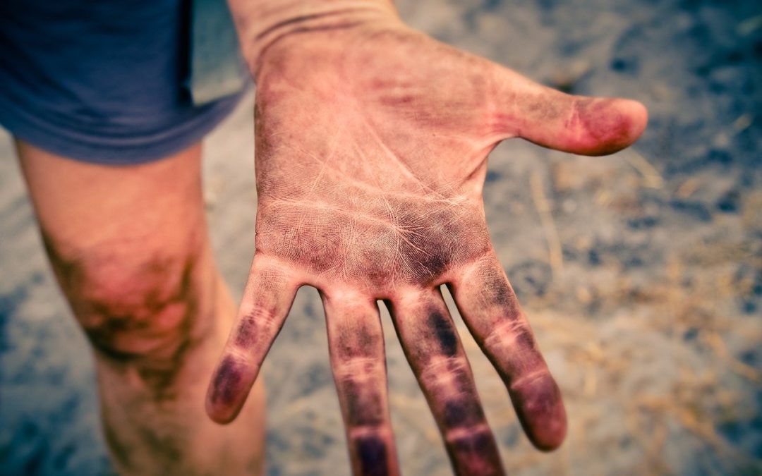 dirty hand - most common hand injuries
