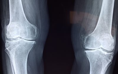 Can Physical Therapy Help Arthritis Pain?