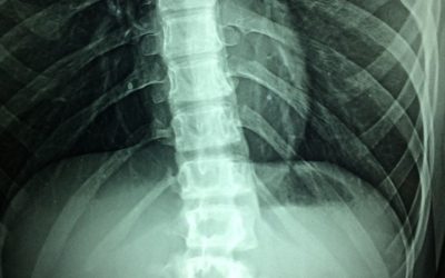 Understanding Your Spine: Scoliosis