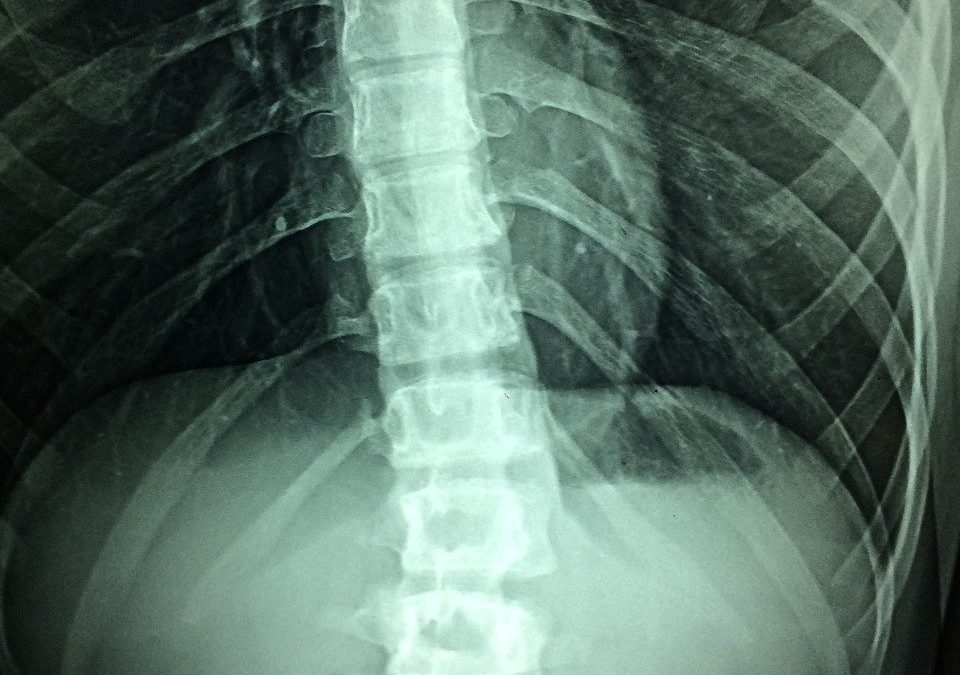 understanding the spine: scoliosis